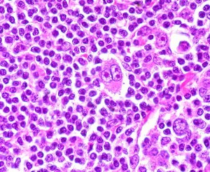 Hodgkin's Disease pathology image shows classic "Reed-Sternberg" cell in center, W-C image