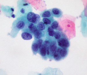 Cervical Cancer Screening Update: on Pap Smears, Liquid-based Cytology and HPV